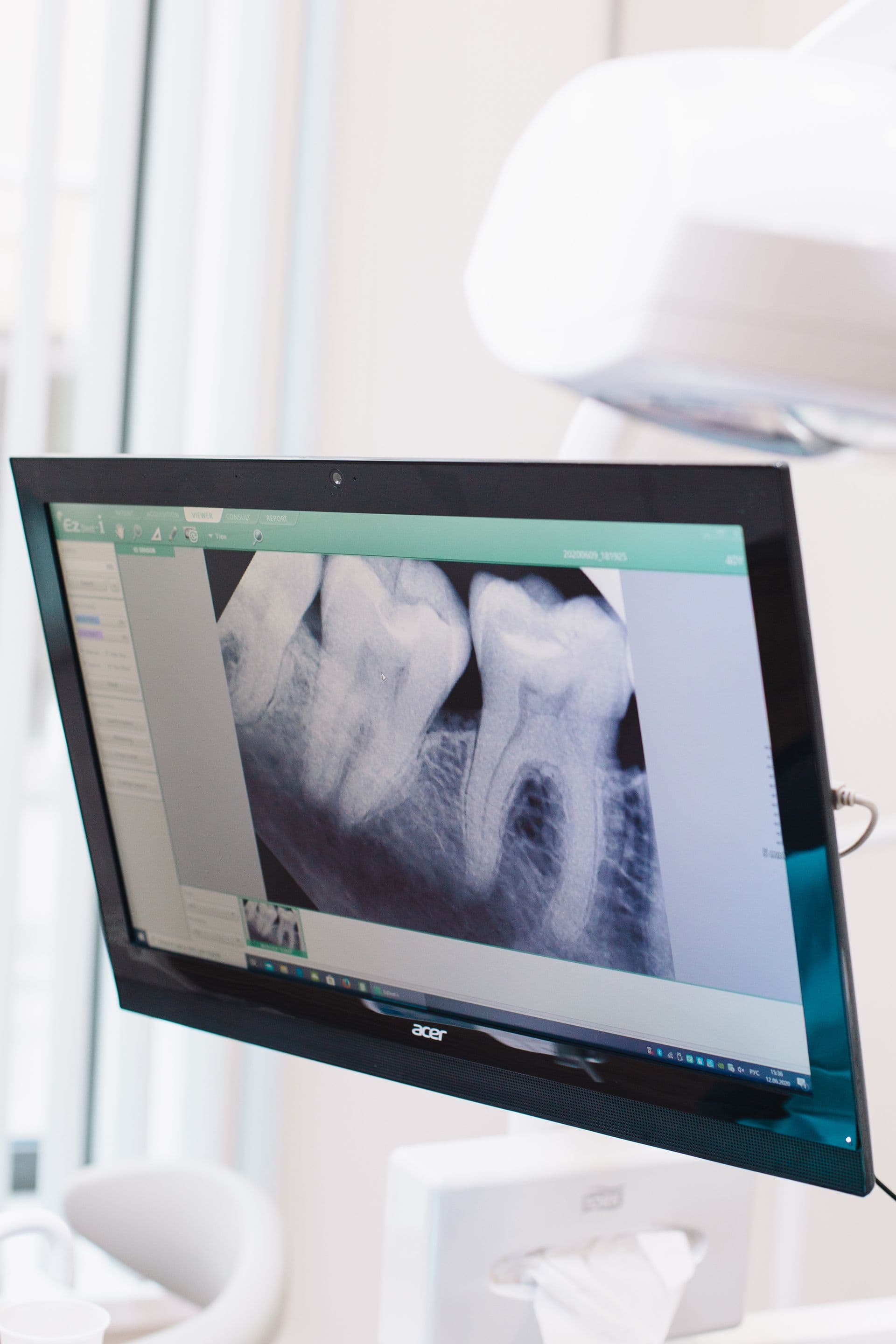 Dental X-ray displayed on an imaging workstation screen
